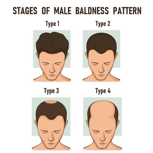 stages of male baldness pattern jpg