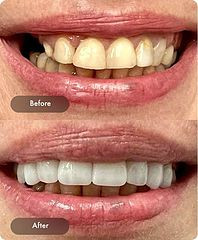 invisalign treatment jpg